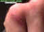 blessures-11.jpg (43089 octets)